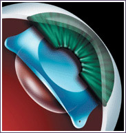 lentilla intraocular presbicia, operacion presbicia, operacion miopia