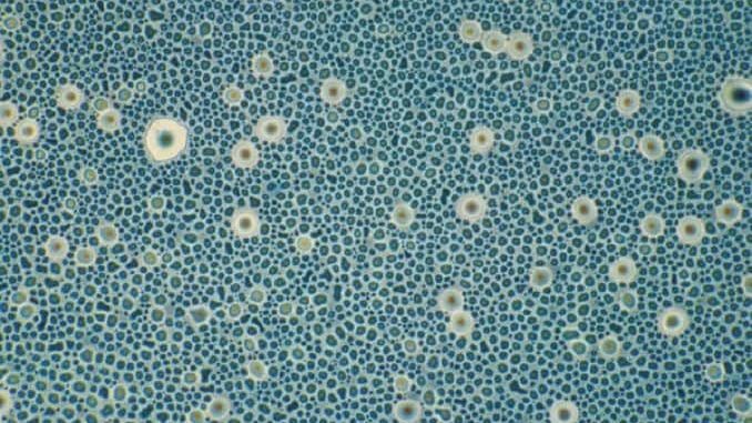 retinopatia-informacion retinopatia diabetica