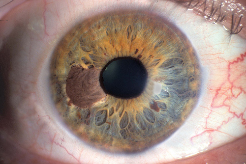cancer melanoma ojo