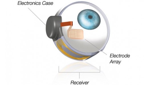 implante retina