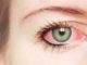 ojo rojo conjuntivitis
