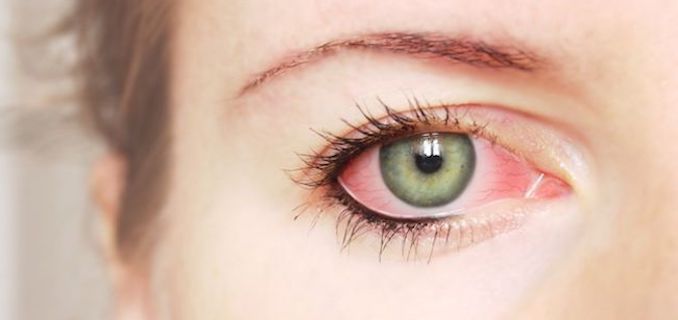 ojo rojo conjuntivitis