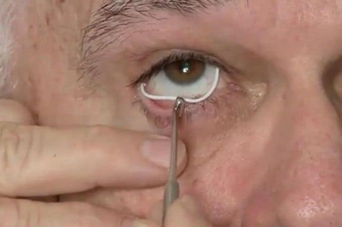 colocar anillo silicona glaucoma