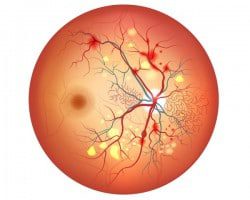 retinopatia diabetica