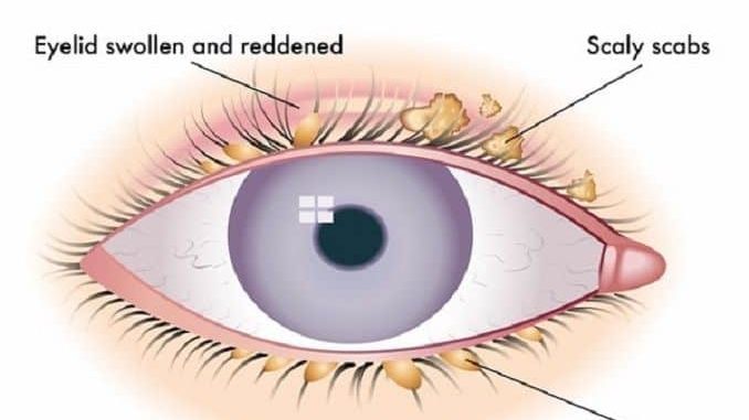 blefaritis ojo curacion