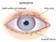 blefaritis ojo curacion