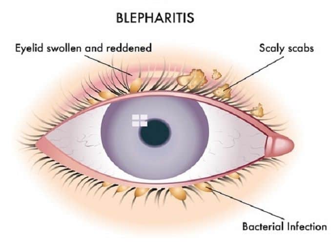 blefaritis ojo curacion